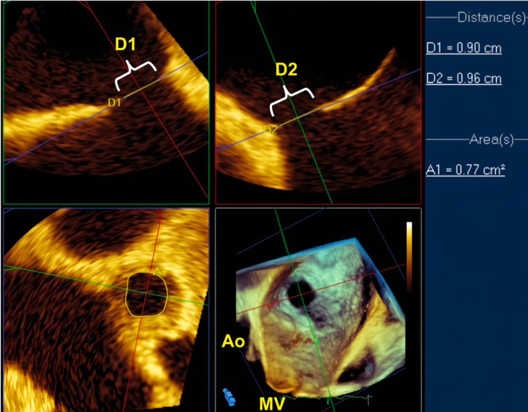 房间隔缺损大小，到底如何测量？