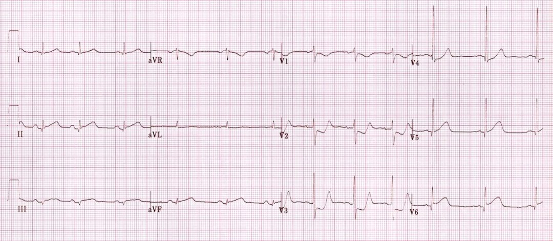 心电图mm单位怎么读12导、15导、18导连接示意图及心脏各壁超声解剖位置与心电图导联对应关系_https://www.jmylbn.com_新闻资讯_第25张
