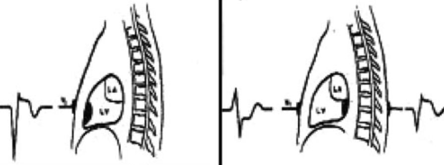心电图mm单位怎么读12导、15导、18导连接示意图及心脏各壁超声解剖位置与心电图导联对应关系_https://www.jmylbn.com_新闻资讯_第20张