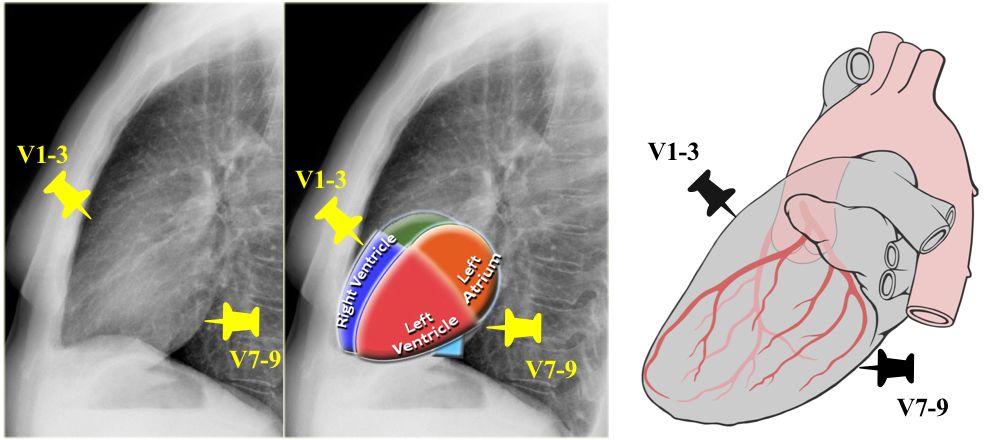 心电图mm单位怎么读12导、15导、18导连接示意图及心脏各壁超声解剖位置与心电图导联对应关系_https://www.jmylbn.com_新闻资讯_第28张