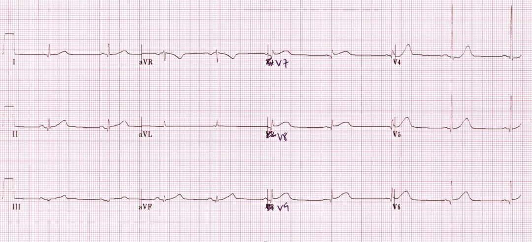 心电图mm单位怎么读12导、15导、18导连接示意图及心脏各壁超声解剖位置与心电图导联对应关系_https://www.jmylbn.com_新闻资讯_第26张