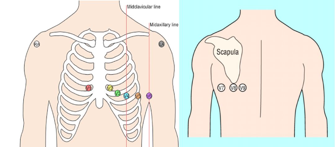 心电图mm单位怎么读12导、15导、18导连接示意图及心脏各壁超声解剖位置与心电图导联对应关系_https://www.jmylbn.com_新闻资讯_第27张
