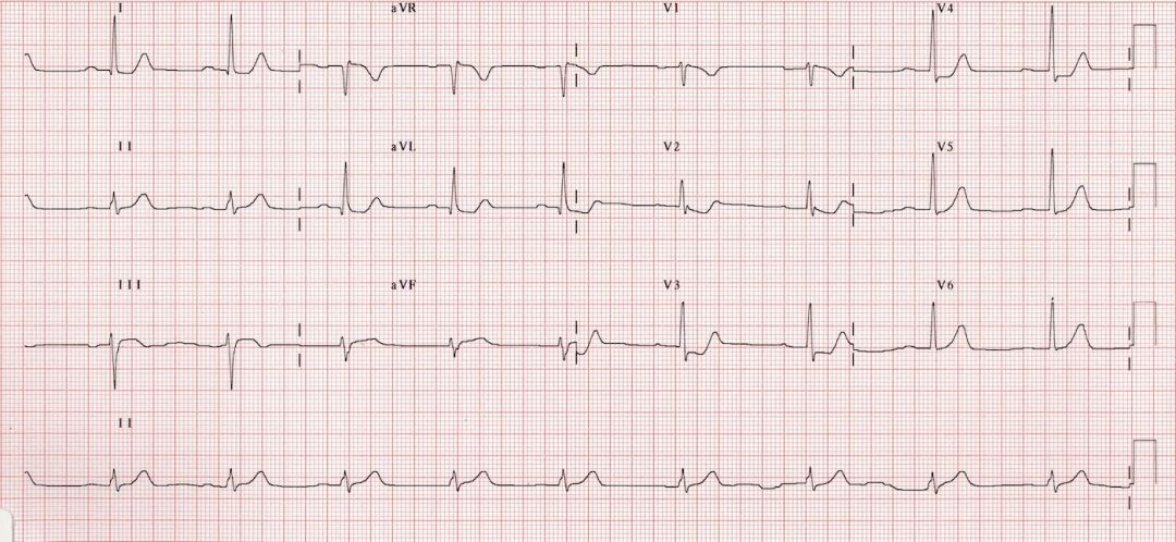 心电图mm单位怎么读12导、15导、18导连接示意图及心脏各壁超声解剖位置与心电图导联对应关系_https://www.jmylbn.com_新闻资讯_第23张
