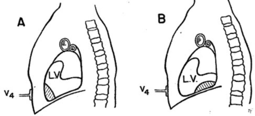 心电图mm单位怎么读12导、15导、18导连接示意图及心脏各壁超声解剖位置与心电图导联对应关系_https://www.jmylbn.com_新闻资讯_第19张