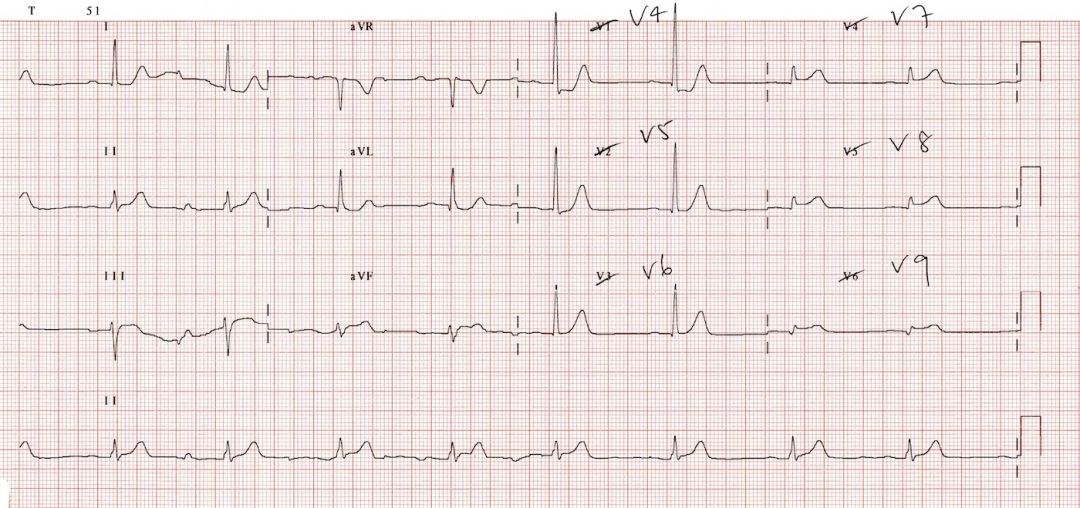 心电图mm单位怎么读12导、15导、18导连接示意图及心脏各壁超声解剖位置与心电图导联对应关系_https://www.jmylbn.com_新闻资讯_第24张