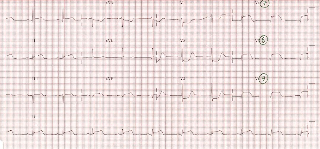 心电图mm单位怎么读12导、15导、18导连接示意图及心脏各壁超声解剖位置与心电图导联对应关系_https://www.jmylbn.com_新闻资讯_第22张