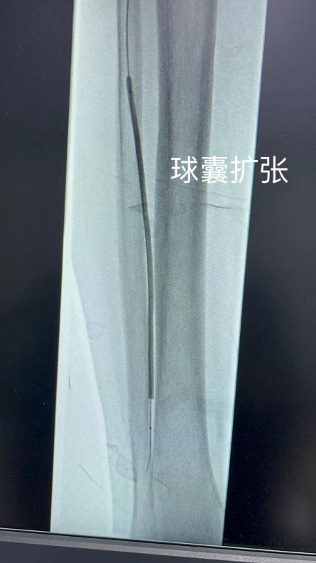 塞球囊怎么取腿“梗”了怎么办？下肢动脉硬化闭塞球囊扩张成形术+支架置入术为“枯腿”打通“活血隧道”_https://www.jmylbn.com_新闻资讯_第5张