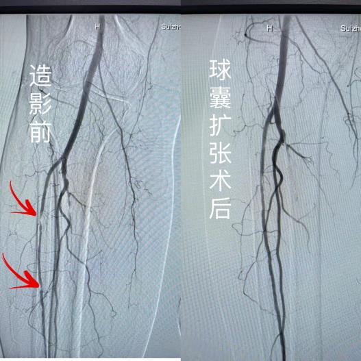 塞球囊怎么取腿“梗”了怎么办？下肢动脉硬化闭塞球囊扩张成形术+支架置入术为“枯腿”打通“活血隧道”_https://www.jmylbn.com_新闻资讯_第6张