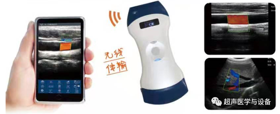 索诺星超声怎么样【一文盘点】市场主流掌上超声_https://www.jmylbn.com_新闻资讯_第26张