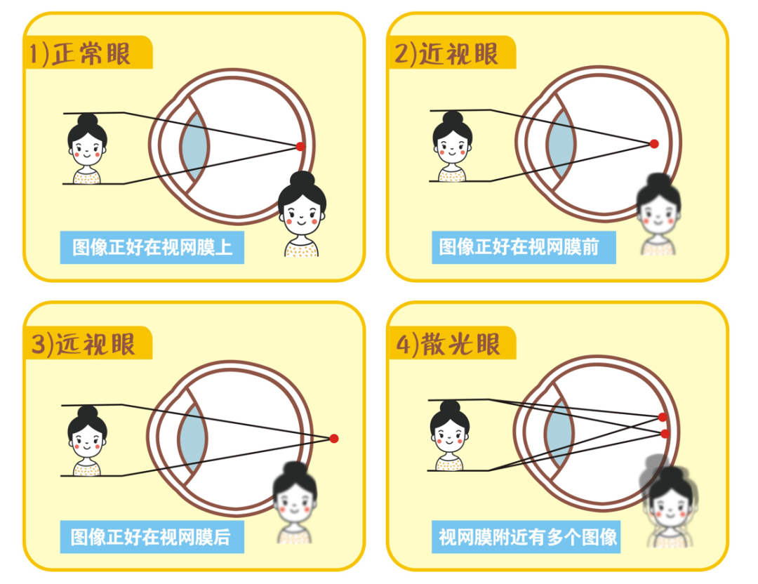 散光和近视一样会逐渐加深吗
