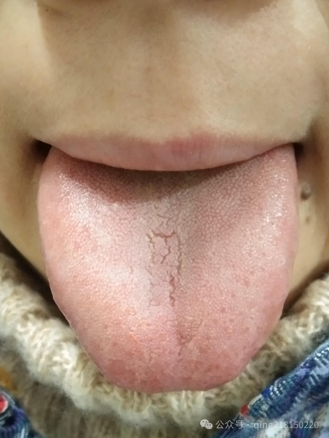 这波流感体质弱的莫要忘了小柴胡汤！