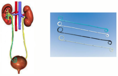 猪输尿管怎么吃科普 ∣ 护士姐姐教你猪尾巴管（输尿管支架）居家护理_https://www.jmylbn.com_新闻资讯_第1张