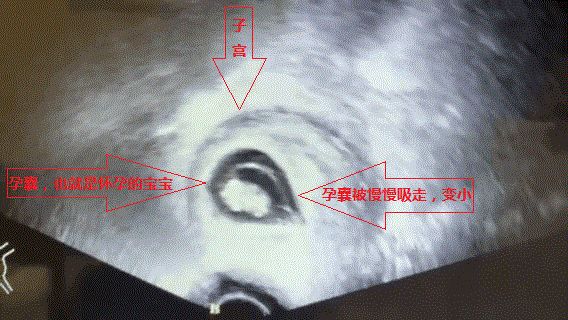 超声引导人流是什么【科普】带您了解“睡一觉”就可完成的无痛人流是怎么进行的。_https://www.jmylbn.com_新闻资讯_第12张