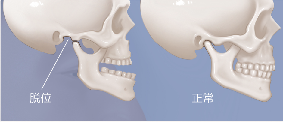 【三水人医】打哈欠下巴竟然"掉了",该如何预防下巴脱臼?