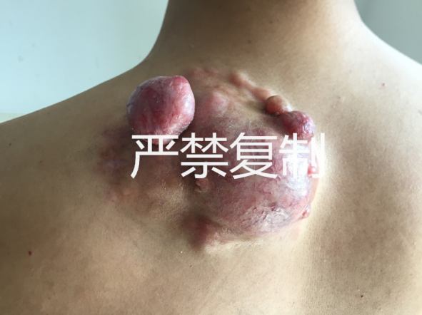 三水人医专科技术大腿小疙瘩竟是恶性肿瘤隆突性皮肤应引起重视