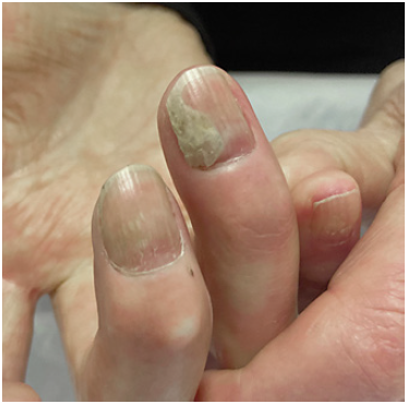 甲真菌病患者拒绝口服药,外用药可治愈吗?