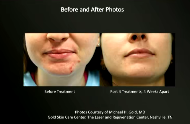 4006B光疗怎么用46%的痤疮患者对现有疗法不满，激光与光疗如何发挥作用？_https://www.jmylbn.com_新闻资讯_第5张