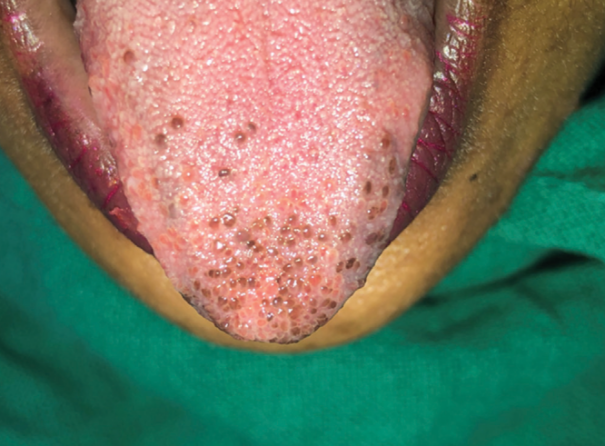 舌头变黑,会是什么病?_医学界-助力医生临床决策和职业成长