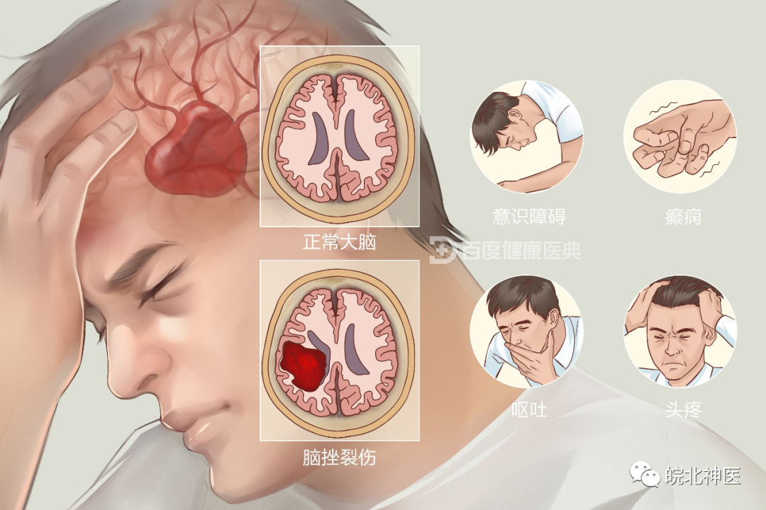 严重脑挫裂伤可合并蛛网膜下隙出血,可导致患者畏光,并有颈项强直