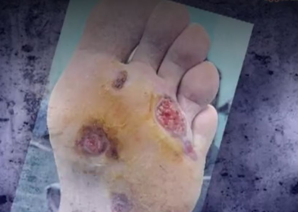 噬肉菌吞噬身体