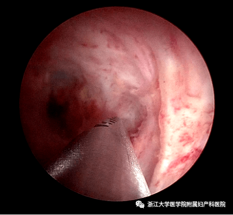宫腔镜器械怎么安装小宫腔，大世界，且看宫腔镜如何发挥大功效_https://www.jmylbn.com_新闻资讯_第7张
