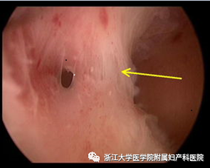 宫腔镜器械怎么安装小宫腔，大世界，且看宫腔镜如何发挥大功效_https://www.jmylbn.com_新闻资讯_第10张
