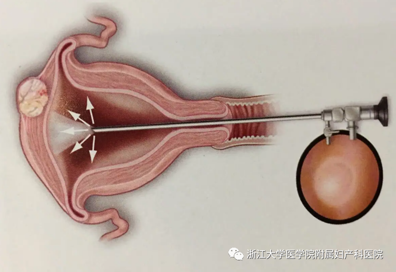 宫腔镜器械怎么安装小宫腔，大世界，且看宫腔镜如何发挥大功效_https://www.jmylbn.com_新闻资讯_第1张