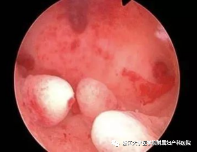 宫腔镜器械怎么安装小宫腔，大世界，且看宫腔镜如何发挥大功效_https://www.jmylbn.com_新闻资讯_第8张