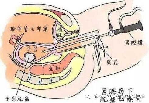 宫腔镜器械怎么安装小宫腔，大世界，且看宫腔镜如何发挥大功效_https://www.jmylbn.com_新闻资讯_第11张