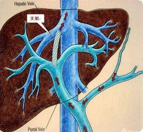 技術突破介入與血管外科成功開展經頸靜脈肝內門腔靜脈內支架分流術
