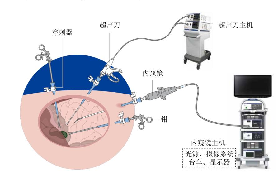 什么是软式内镜镜【产业解读】医用内窥镜及其市场简析_https://www.jmylbn.com_新闻资讯_第6张