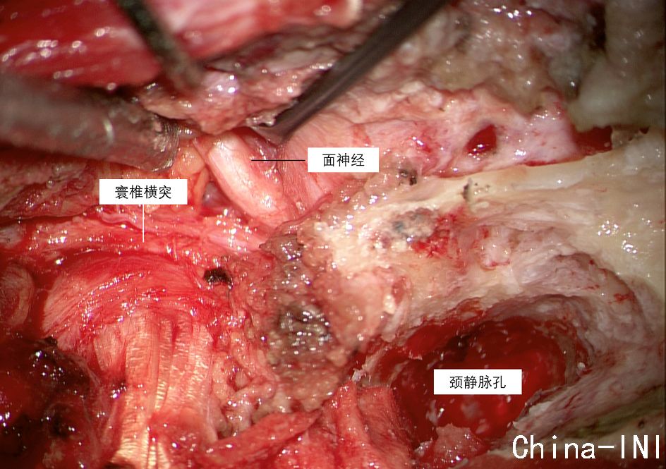 胸锁乳突肌切断术图片
