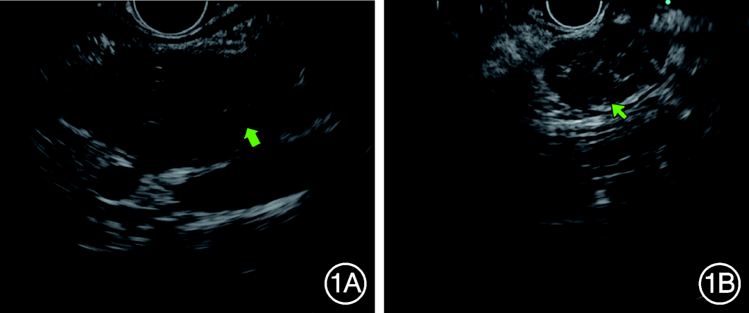 prosound超声怎么调查看部位202402论著 ｜ IgG4相关自身免疫性胰腺炎临床及超声内镜特征分析_https://www.jmylbn.com_新闻资讯_第8张