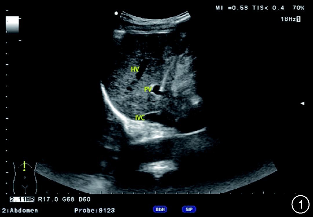 测胆道压力怎么测202205专论｜门静脉压力测定的常用方法与前景_https://www.jmylbn.com_新闻资讯_第5张