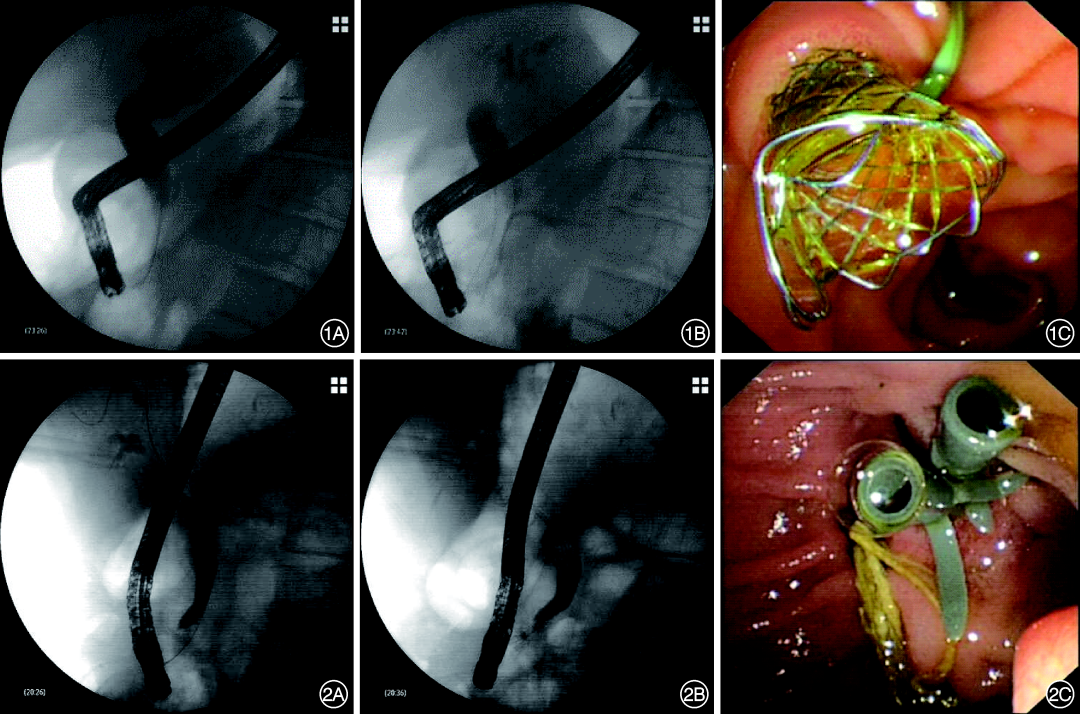 胆管支架什么样子202203论著｜全覆膜自膨式金属支架和多根塑料支架治疗良性胆管狭窄的对比研究_https://www.jmylbn.com_新闻资讯_第2张