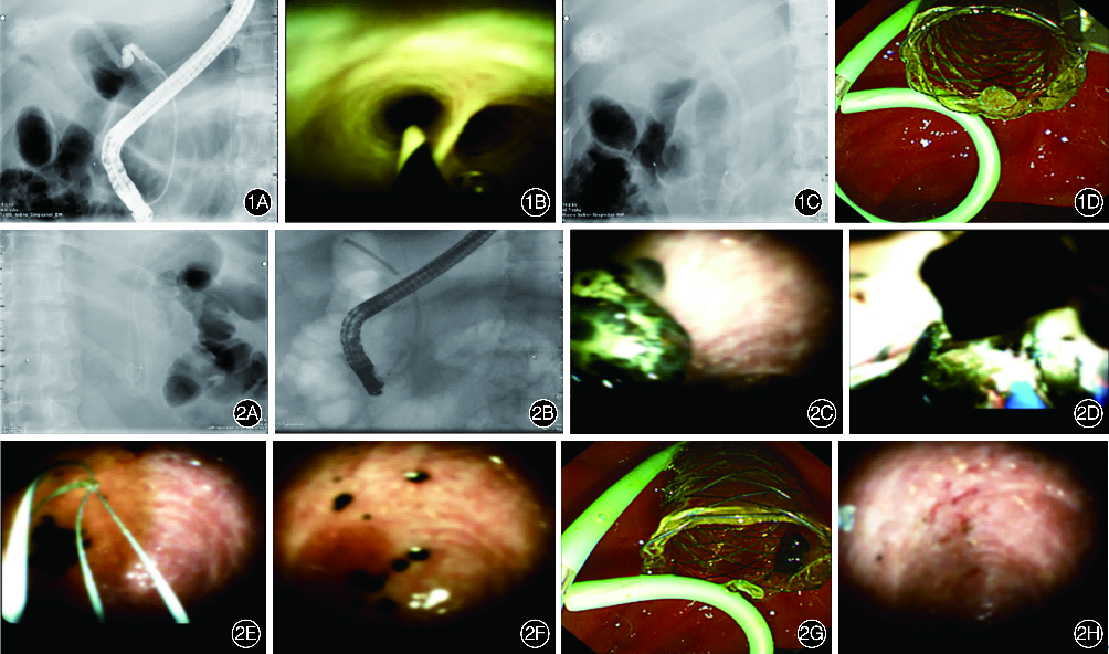 波科支架怎么样202407论著｜负压吸引法在内镜下经十二指肠乳头保胆取石术中的应用研究_https://www.jmylbn.com_新闻资讯_第4张