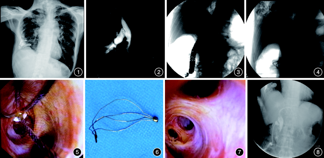 取石篮是什么202204病例｜经内镜逆行胰胆管造影术中取石网篮嵌顿肝内胆管1例_https://www.jmylbn.com_新闻资讯_第2张