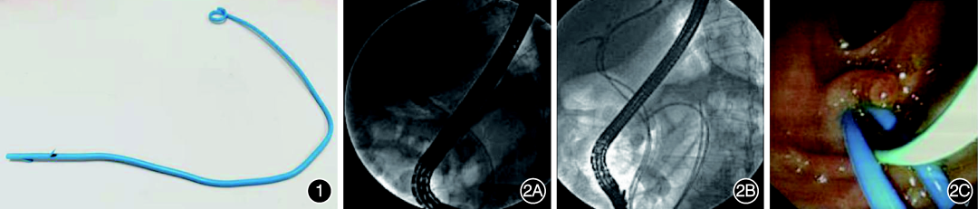 单猪尾支架怎么放202206论著｜猪尾型鼻胆引流管改制新型胆管塑料支架在肝门部胆管癌中的应用_https://www.jmylbn.com_新闻资讯_第4张