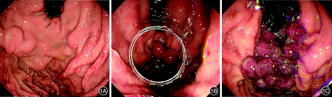 套扎环怎么下202501论著｜非急诊状态食管静脉曲张套扎联合胃静脉曲张密集套扎的有效性及安全性_https://www.jmylbn.com_新闻资讯_第5张