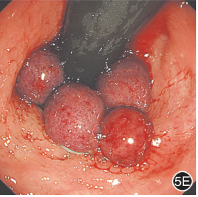 套扎环怎么下专家论坛｜内痔消化内镜下套扎治疗的现状与发展_https://www.jmylbn.com_新闻资讯_第9张