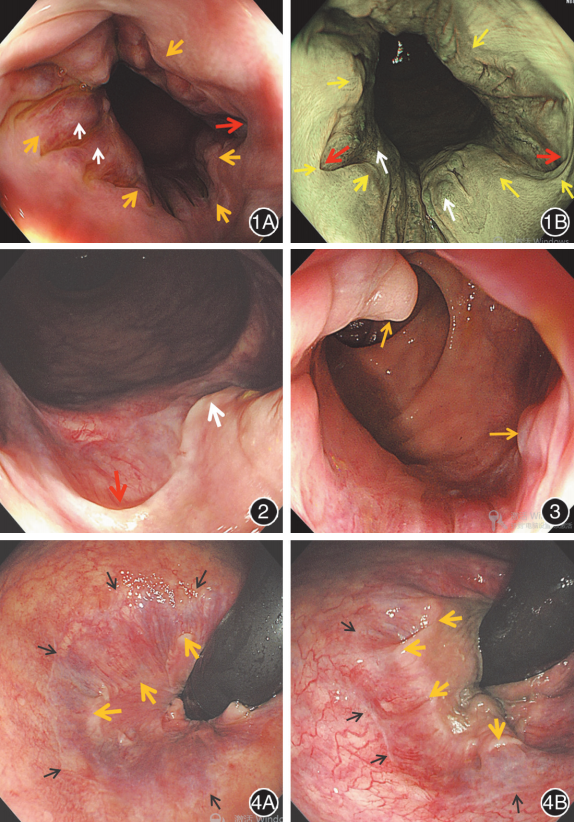 套扎环怎么下专家论坛｜内痔消化内镜下套扎治疗的现状与发展_https://www.jmylbn.com_新闻资讯_第7张