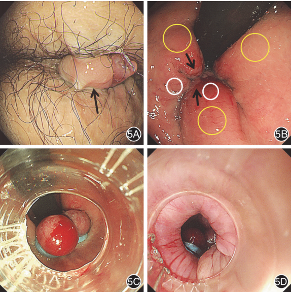 套扎环怎么下专家论坛｜内痔消化内镜下套扎治疗的现状与发展_https://www.jmylbn.com_新闻资讯_第8张