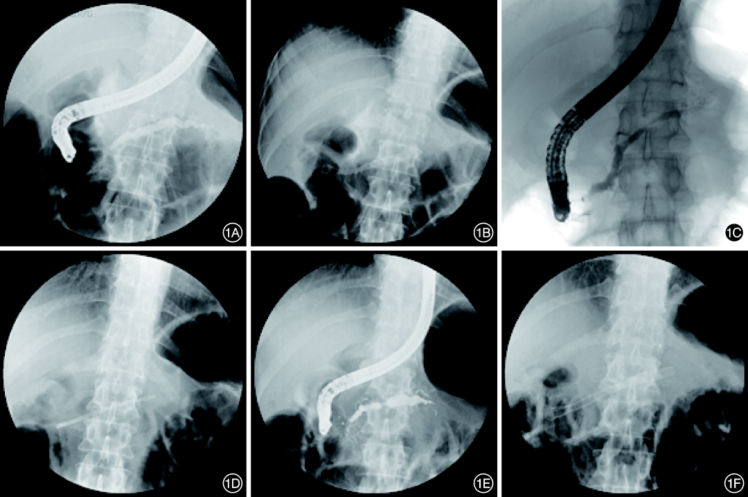 斑马导丝是治疗什么的202206论著｜全覆膜自膨式金属支架治疗难治性胰管良性狭窄的长期疗效观察（含视频）_https://www.jmylbn.com_新闻资讯_第5张