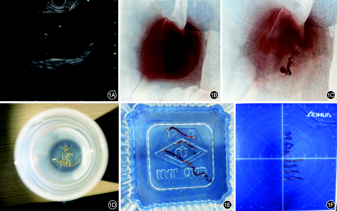 活检MM什么202402论著 ｜超声内镜引导下肝脏穿刺活检术在肝移植受者中的应用价值_https://www.jmylbn.com_新闻资讯_第4张
