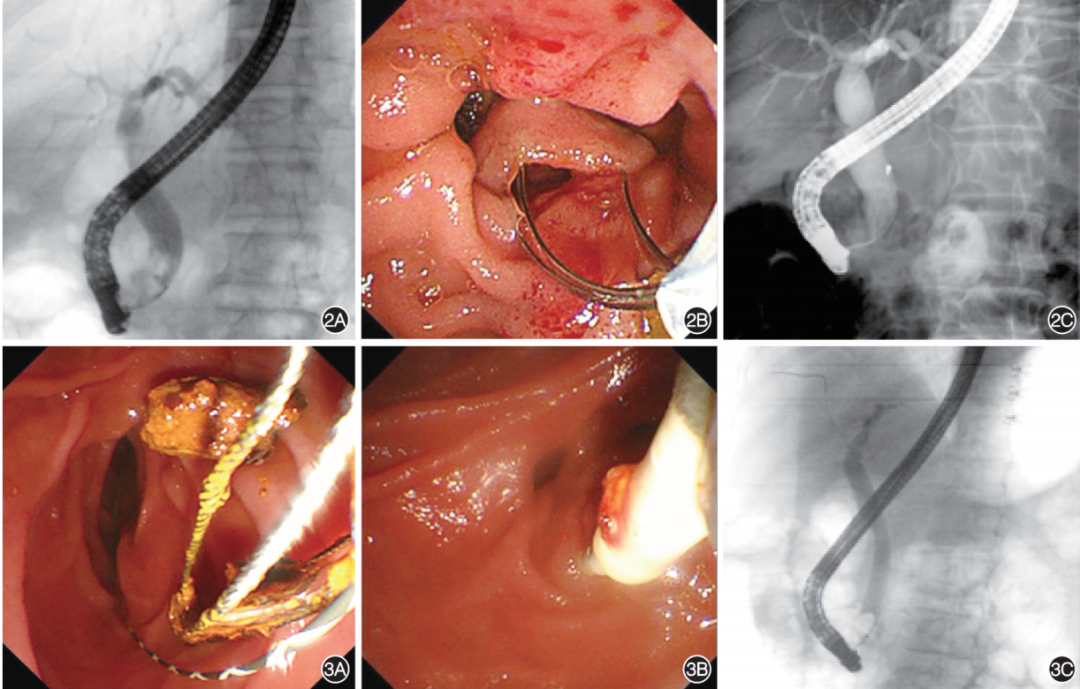 取石网篮 为什么贵202507论著｜胆总管结石网篮取石后生理盐水冲洗与网篮联合球囊取石的疗效对比_https://www.jmylbn.com_新闻资讯_第4张