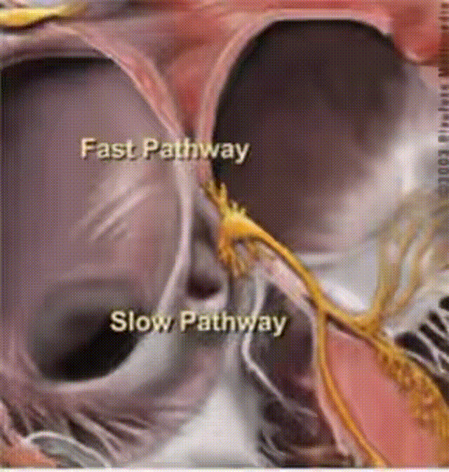 心律解码丨房室结折返性心动过速的心电图特点与机制
