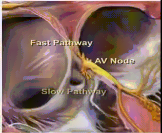心律解码丨房室结折返性心动过速的心电图特点与机制
