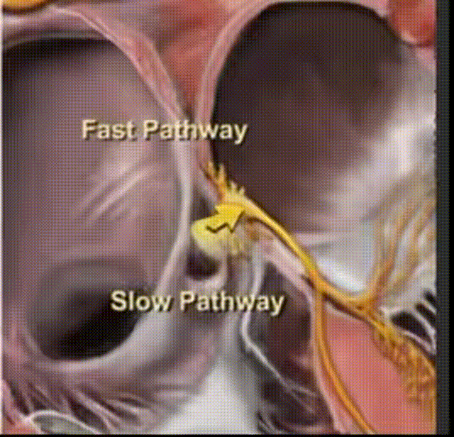 心律解码丨房室结折返性心动过速的心电图特点与机制