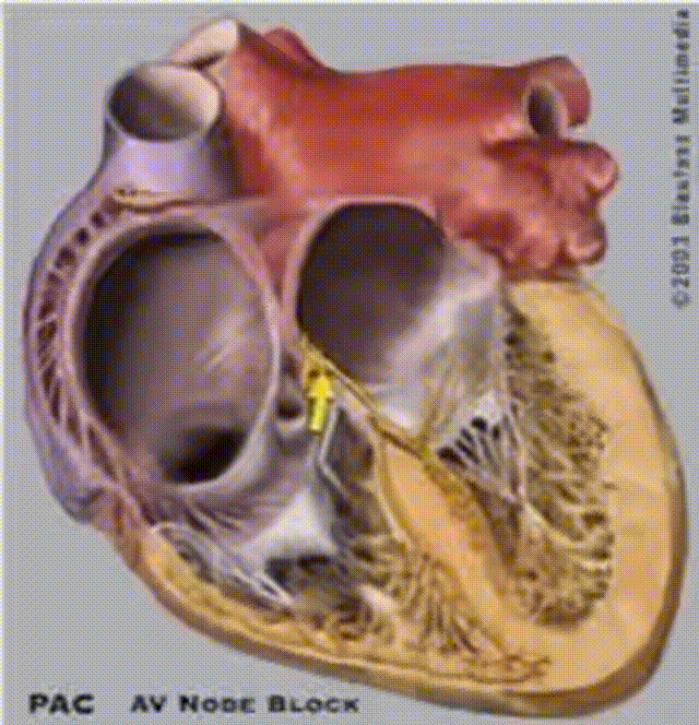 心律解码丨房室结折返性心动过速的心电图特点与机制