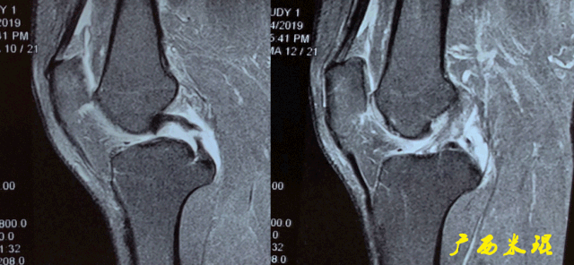 干货：高清动图学前交叉韧带MRI诊断，经典珍藏版！